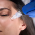 Mesoterapia facial en Elche: el secreto para devolverle vitalidad y frescura a tu piel